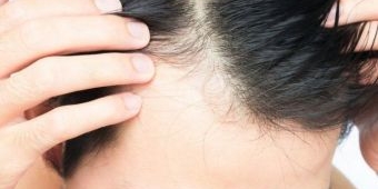 Kekurangan 7 Vitamin Ini Dapat Menyebabkan Kebotakan, Simak Penjelasannya