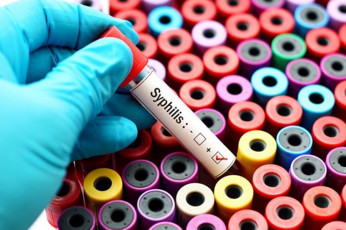 Kemenkes Sebut Kasus Sifilis Naik 70 Persen, Pakar UM Berikan Cara Mencegahnya Kemenkes Sebut Kasus Sifilis Naik 70 Persen, Pakar UM Berikan Cara Mencegahnya