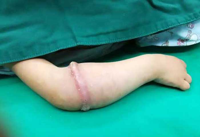 Karet gelang yang tertanam di bawah kulit. foto: metro.co.uk