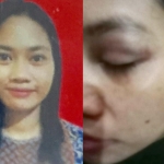 Luka lebam di wajah Lusi Febrianti yang diduga jadi korban penganiayaan
