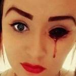 Marnie selfie saat matanya digenangi darah. Sungguh mengerikan. foto: repro mirror.co.uk