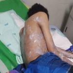 Salah satu anak yang jadi korban penyiraman air keras oleh karyawan CV Mentari.