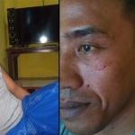Korban Abdul Hakim alias Buleng menunjukkan luka-luka di wajahnya.