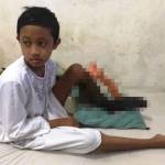 Setyo Aldi (13), warga Jl.KH.Malik Dalam RT 04 RE 7, Dusun Baran Buring, Kelurahan Buring, Kedungkandang, Kota Malang, kaki kirinya membusuk.