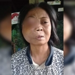 Kondisi mata Jariah yang semakin membesar.