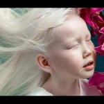 Nariyana, Gadis Albino yang menjadi terkenal dan penuh pesona.