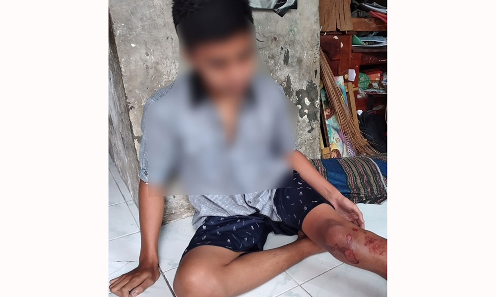 MN (17), korban begal di Sidoarjo saat menunjukkan bekas luka pengeroyokan.