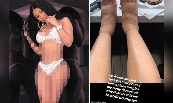 Memaksa Naik Pesawat Usai Operasi Plastik, Tubuh Cardi B Bengkak-bengkak