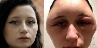 Pakai Semir Rambut, Wajah Wanita Ini Bengkak Gak Karuan