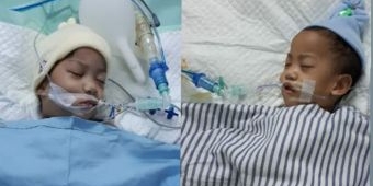 ​9 Jam Operasi, Bayi Kembar Siam Asal Kendari Sultra Berhasil Dipisahkan