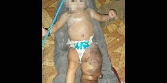 Bayi Penderita Lymphangioma di Pamekasan Membutuhkan Uluran para Dermawan