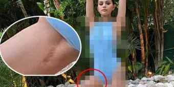 Selena Gomez Pamer Bekas Sayatan Operasi Transplantasi Ginjal