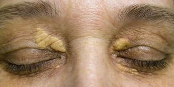 Gejala Xanthelasma dan Cara Mengatasinya