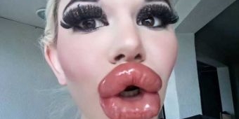 Menurut Anda, Ini Perempuan Waras apa Ndak? Dia Bangga Punya Bibir Terjontor di Dunia