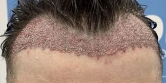 Transplantasi Rambut yang Gagal, Jadi Bikin Bergidik