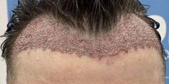 ​Transplantasi Rambut yang Gagal, Jadi Bikin Bergidik