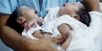 Jalani Operasi Pemisahan Organ, Kembar Siam Dempet Perut di Sidoarjo Meninggal Dunia