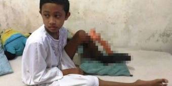 Kaki Pasien Alami Pembusukan Setelah 2 Kali Operasi, Ini Penjelasan RSSA Malang