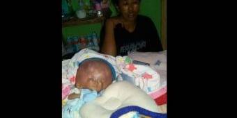 Bayi Pengidap Hydrocephalus di Trenggalek Akhirnya Dilarikan ke RSUD Dr. Soetomo