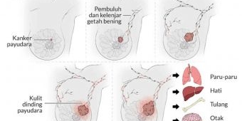 Ini Cara Cegah Kanker Payudara, Salah Satunya dengan Menyusui