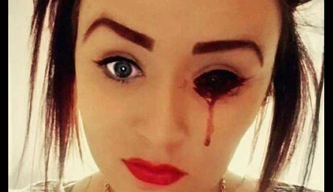 Marnie selfie saat matanya digenangi darah. Sungguh mengerikan. foto: repro mirror.co.uk
