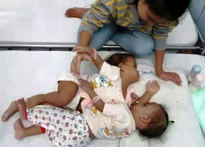 Usai Kateterisasi, Kembar Siam dari Rogojampi Tetap Ceria Usai Kateterisasi, Kembar Siam dari Rogojampi Tetap Ceria