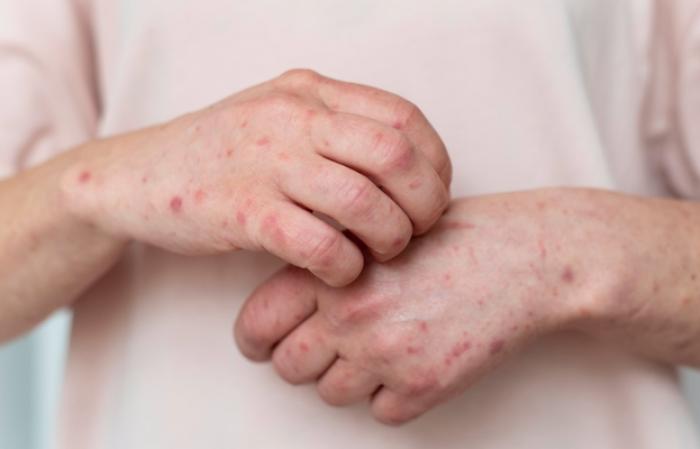 Kemenkes Pastikan Monkeypox Bukan Efek Samping Vaksin Covid-19 Kemenkes Pastikan Monkeypox Bukan Efek Samping Vaksin Covid-19