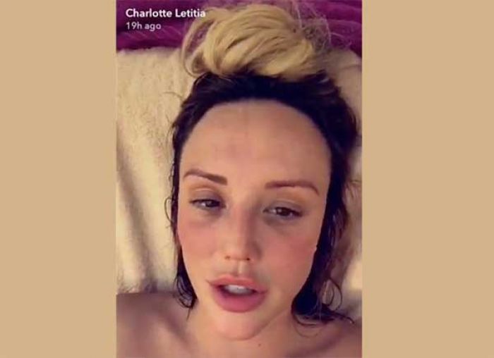 Charlotte Crosby Mengklaim Bibirnya Seksi dari Sononya