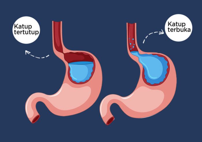 Benarkah Asam Lambung Dapat Sebabkan Kematian? Simak Penjelasannya Benarkah Asam Lambung Dapat Sebabkan Kematian? Simak Penjelasannya