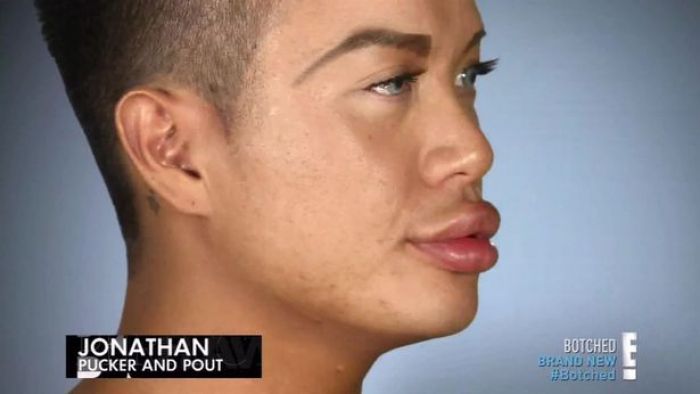 Bibir Terlalu Tebal Kebanyakan Disuntik, Pria ini Tak Bisa Menutup Mulutnya Bibir Terlalu Tebal Kebanyakan Disuntik, Pria ini Tak Bisa Menutup Mulutnya