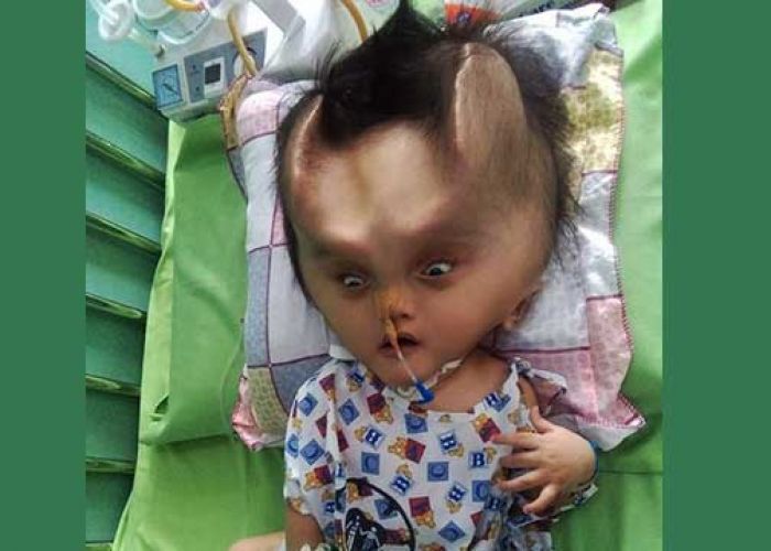 Usai Dioperasi, Bayi ini Tumbuh Usai Dioperasi, Bayi ini Tumbuh