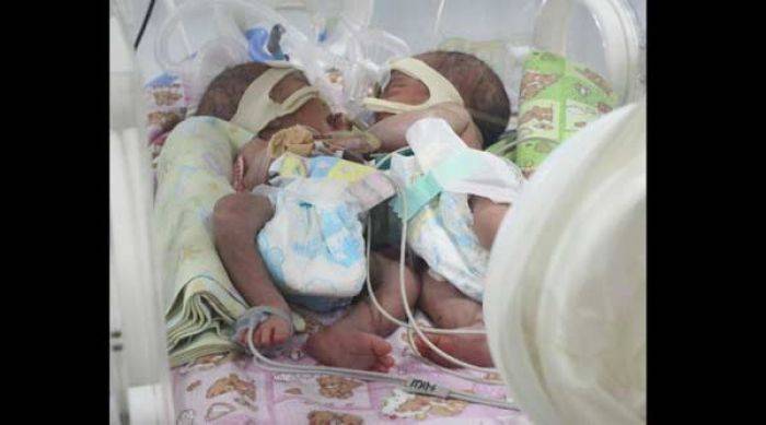 Bayi Kembar Siam Dempet Perut Lahir Prematur di RSUD Sidoarjo 