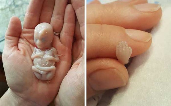 Subhanallah, Diaborsi, Jabang Bayi Usia 14 Minggu Terlihat Sangat Sempurna Subhanallah, Diaborsi, Jabang Bayi Usia 14 Minggu Terlihat Sangat Sempurna