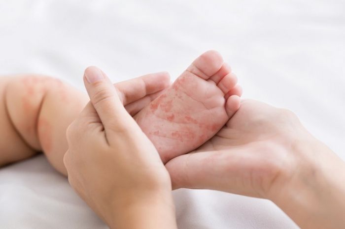 Mengkhawatirkan! Dinkes Pamekasan Catat Kasus Campak per September Melonjak, 17 Desa Dinyatakan KLB Mengkhawatirkan! Dinkes Pamekasan Catat Kasus Campak per September Melonjak, 17 Desa Dinyatakan KLB