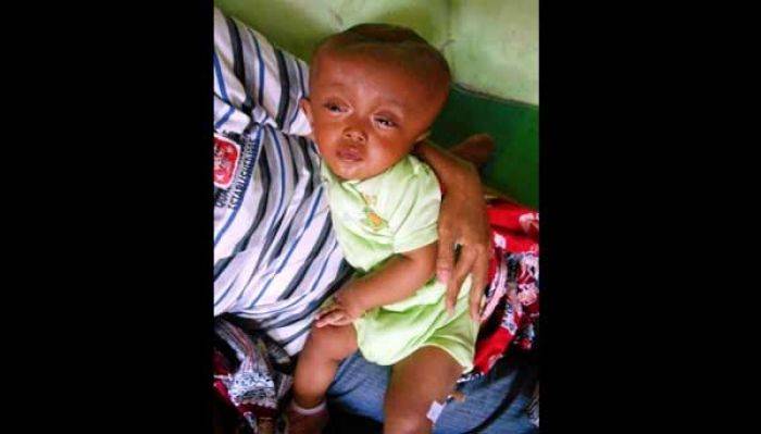 Karena Miskin, Anak Idap Hedrosepalus di Sukomoro Nganjuk Tak Rutin Diobatkan Karena Miskin, Anak Idap Hedrosepalus di Sukomoro Nganjuk Tak Rutin Diobatkan
