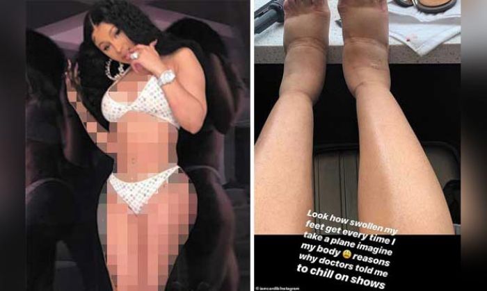 Memaksa Naik Pesawat Usai Operasi Plastik, Tubuh Cardi B Bengkak-bengkak Memaksa Naik Pesawat Usai Operasi Plastik, Tubuh Cardi B Bengkak-bengkak