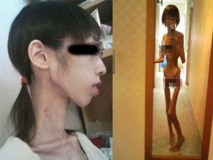 Naudzubillahi Min Dzaaliq, Begini Perempuan Derita Gizi Buruk Selfie Telanjang Naudzubillahi Min Dzaaliq, Begini Perempuan Derita Gizi Buruk Selfie Telanjang