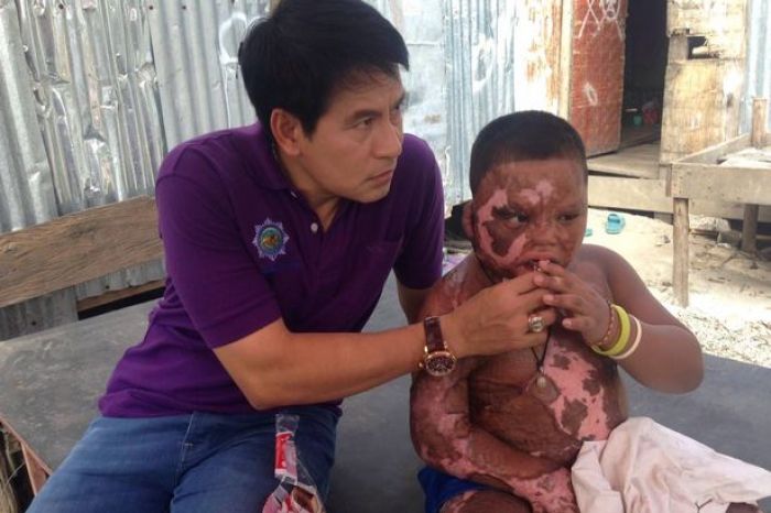 Mainan Tabung Elpiji, Bocah Ini Terbakar 80 Persen Mainan Tabung Elpiji, Bocah Ini Terbakar 80 Persen