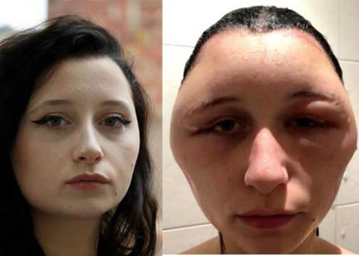 Pakai Semir Rambut, Wajah Wanita Ini Bengkak Gak Karuan Pakai Semir Rambut, Wajah Wanita Ini Bengkak Gak Karuan