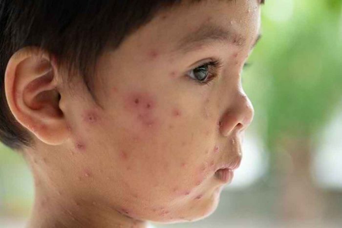 Virus Varicella-Zoster, Penyebab Cacar Air? Gejala, Risiko dan Pengobatannya