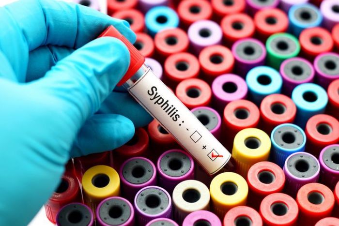 Kemenkes Sebut Kasus Sifilis Naik 70 Persen, Pakar UM Berikan Cara Mencegahnya