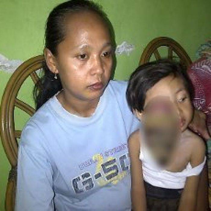 Tumor Mata Fadil Segera Dioperasi Tumor Mata Fadil Segera Dioperasi