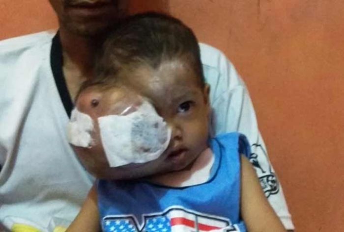 Balita Ini Menderita Penyakit Kanker di Mata Sejak Umur 1 Tahun Balita Ini Menderita Penyakit Kanker di Mata Sejak Umur 1 Tahun