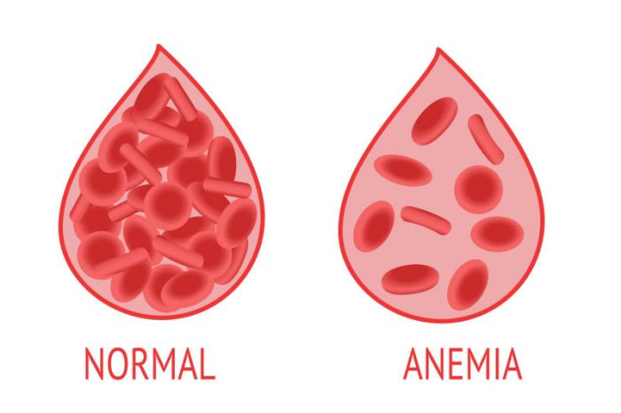 Tips Mencegah Anemia Pada Remaja Tips Mencegah Anemia Pada Remaja