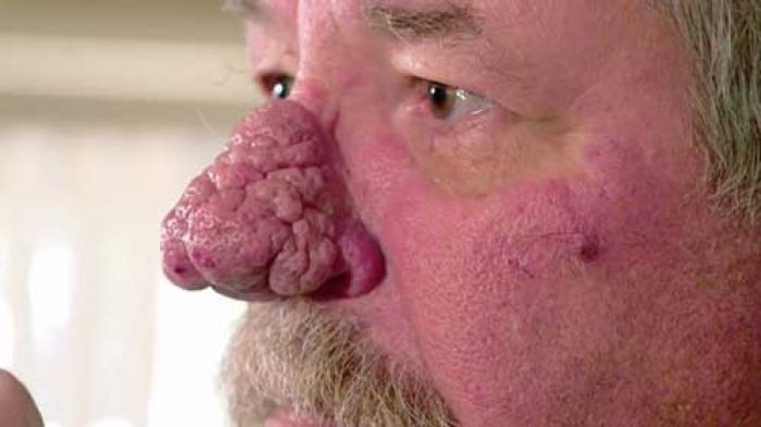Waspada Pakai Krim Tabir Surya! Usai Pakai, Hidung Pria ini Terus Tumbuh Waspada Pakai Krim Tabir Surya! Usai Pakai, Hidung Pria ini Terus Tumbuh
