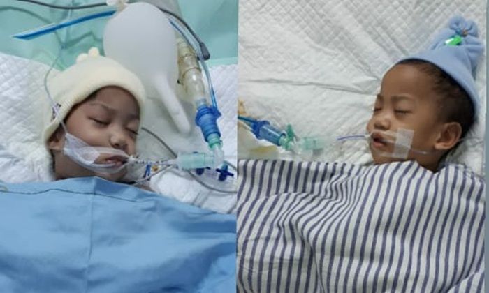 9 Jam Operasi, Bayi Kembar Siam Asal Kendari Sultra Berhasil Dipisahkan