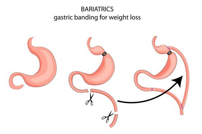 Operasi Potong Lambung dapat Menurunkan Berat Badan Operasi Potong Lambung dapat Menurunkan Berat Badan