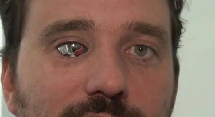 Mata Bionic, Bikin yang Buta Bisa Melihat