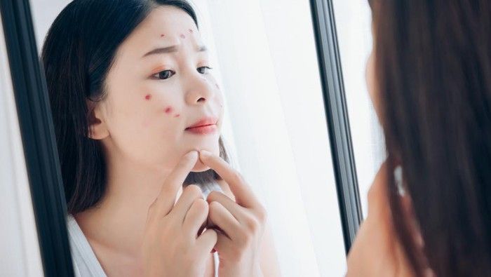 Cara Mencegah Jerawat Muncul Berulang Kali di Tempat yang Sama Cara Mencegah Jerawat Muncul Berulang Kali di Tempat yang Sama