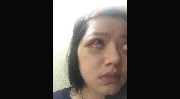 Wajah dan Mata Dita Lebam, Ngaku Dianiaya Anggota DPR, Masinton Membantah Wajah dan Mata Dita Lebam, Ngaku Dianiaya Anggota DPR, Masinton Membantah